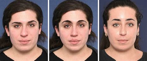 Sense And Non Sense Of Simulations Before Your Facial Feminization Surgery 2pass Clinic