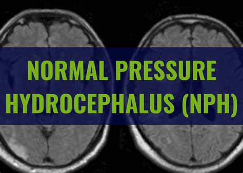 Normal Pressure Hydrocephalus NPH Memory Movement Charlotte
