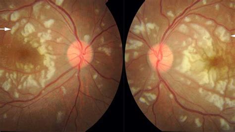 Lupus Detected Through Eye Examination