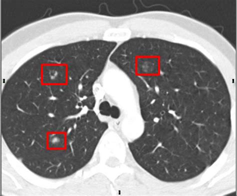 Abnormal Chest Ct Scan With Contrast
