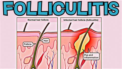 What Is Folliculitis Folliculitis Explained In Minutes Signs