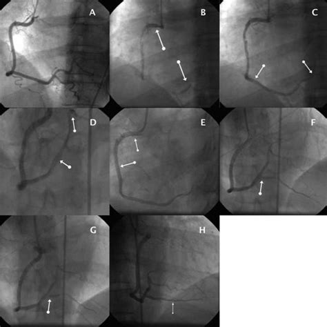 Reformatted Images From An Ecg Gated Ct Coronary Angiogram A
