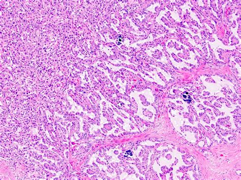 Pathology Outlines Alk Translocation Renal Cell Carcinoma