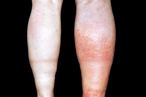 Deep Vein Thrombosis In The Leg Photograph By Dr P Marazziscience Photo Library