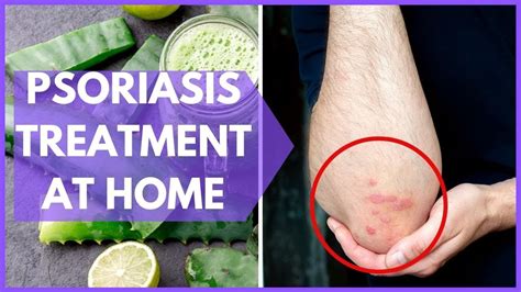 👉 Psoriasis Treatment At Home 💊 10 Psoriasis Remedies At Home Youtube