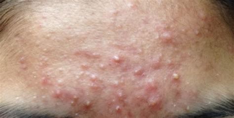 Is It Acne Or Pityrosporum Folliculitis With Pic General Acne