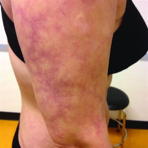Images Of Livedo Reticularis Of Right Foot And Left Hand Download