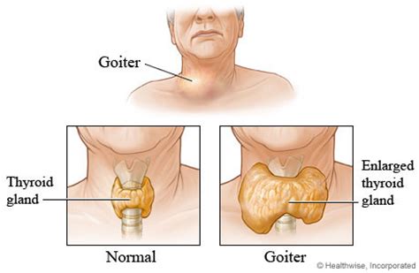 Plummer's nail is a clinical sign in which there is onycholysis, or separation of the nail from the nail bed, particularly affecting the ring and little fingers. Goiter And Thyroid Pictures