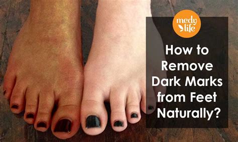 How To Remove Dark Marks From Feet Naturally Foot Remedies Skin