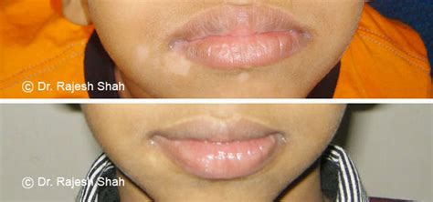 Vitiligo On Lips Images