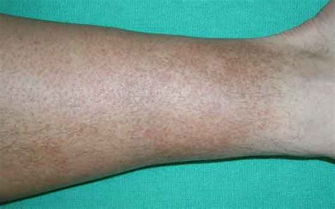 Brown Skin Discoloration On Lower Legs Ankles Face