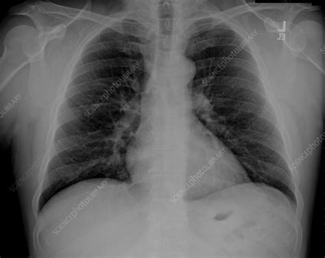 Normal Chest X Ray Preparing For A Chest X Ray Radiology Of Indiana