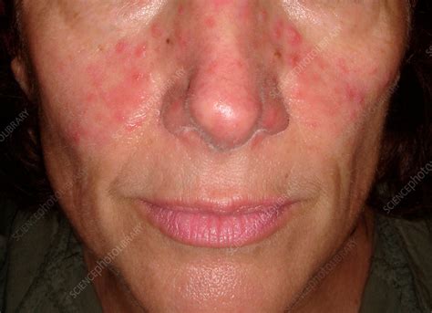 Acne Rosacea Stock Image C0372739 Science Photo Library