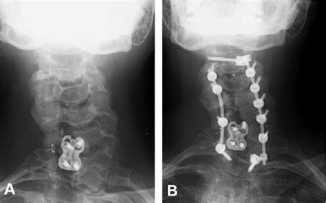 Figure 1 From Cervical Scoliosis Clinical And Radiographic Outcomes