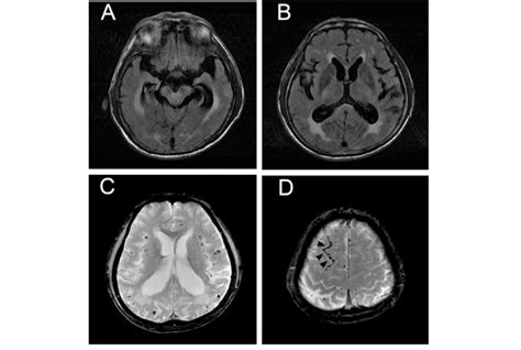 Axial Brain Mri Showing Atrophy Of The Medial Temporal Lobes A