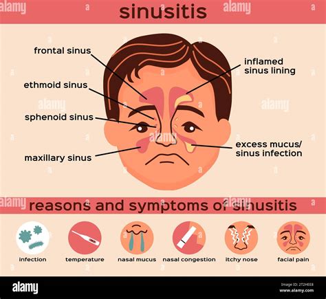 Nasal Disease Flat Infographics Layout With Reasons And Symptoms Of