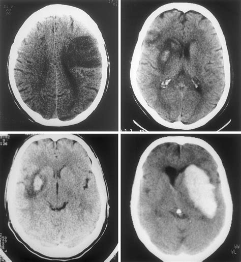 Hemorrhagic Transformation Within 36 Hours Of A Cerebral Infarct Stroke