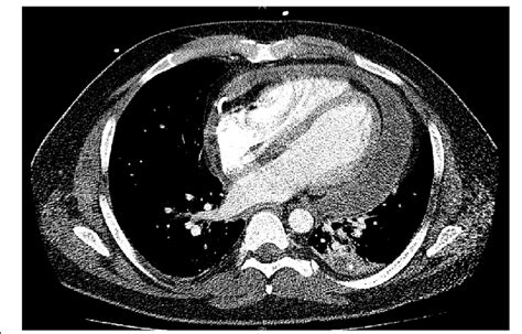 Axial Computed Tomography Scan Of Chest Showing Pericardial Effusion