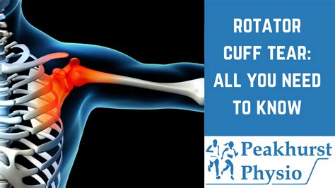 Rotator Cuff Tears 5 Essential Questions Answered
