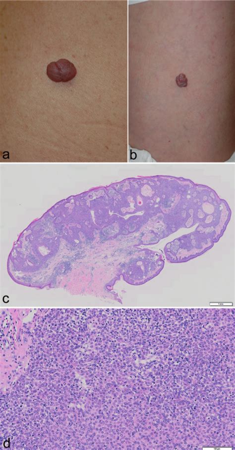 Clinical Appearance Of Case 4 A Pedunculated Nodules On The Left