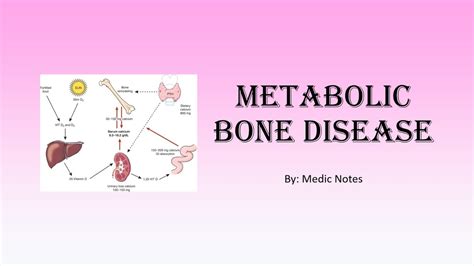 Metabolic Bone Disease Ricketsosteomalacia Pagets Disease