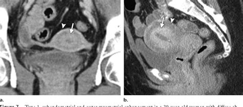 figure 23 from normal or abnormal demystifying uterine and cervical contrast enhancement at