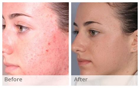 Can chemical peels fade acne scars? Best Chemical Peels For Acne Scars