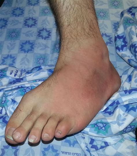 Erysipelas Like Erythema In A Patient With Familial Mediterranean Fever