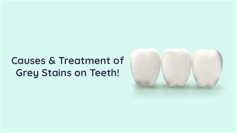 Causes And Treatment For Gray Stains On Teeth