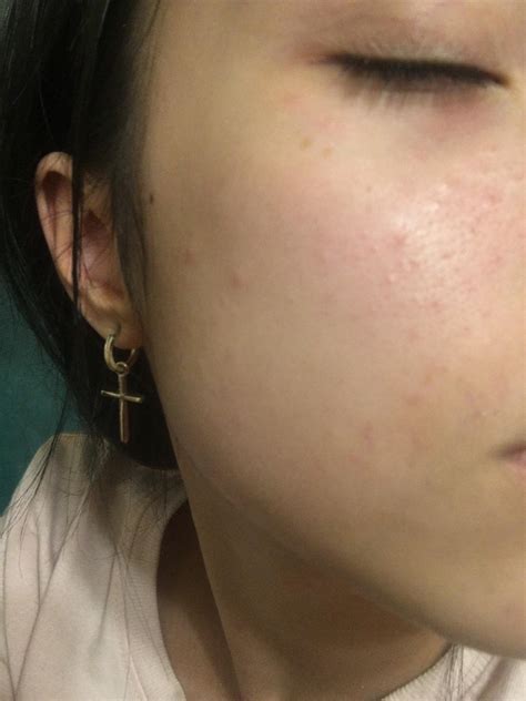 Skin Concerns These Little Red Bumps Appeared On My Face They Are