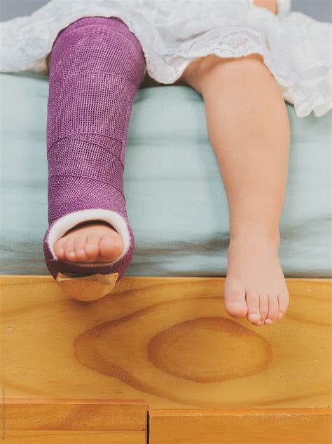 Annonymous View Of A Toddlers Leg In A Purple Cast Hanging From Bed