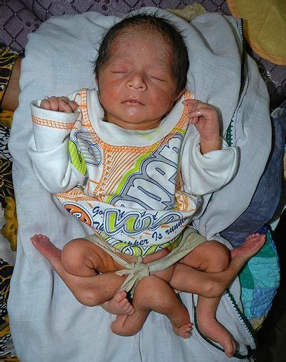 Pakistani Baby Born With 6 Legs Nairobi Wire