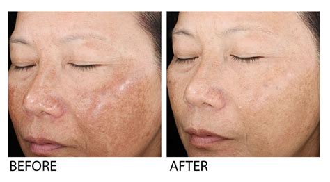 Skin Peel Before After Dr Chen Tai Ho
