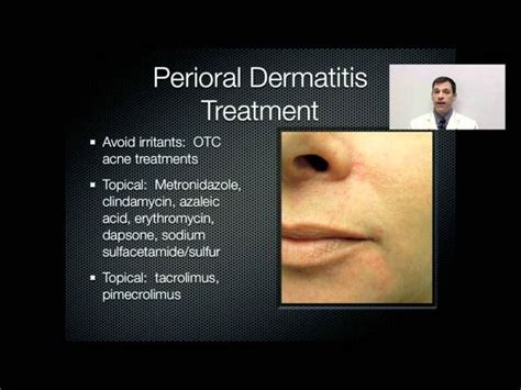 Perioral Dermatitis Is A Common Skin Condition Which Typically Affects