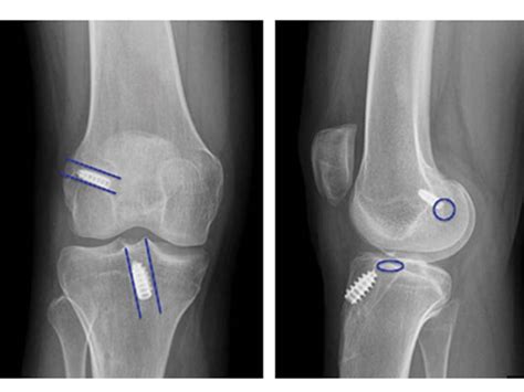 Acl Tear Knee And Sports Orthobullets