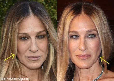 Sarah Jessica Parker Plastic Surgery Comparison Photos