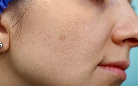 How Can You Fix Sun Damaged Skin Steele Creek Dermatology