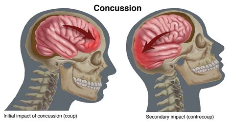 Its Concussion Season How Can You Prevent A Concussion Mississauga