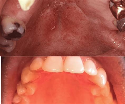 Roof Of Mouth Itchycommon Sign5 Causes And Treatment