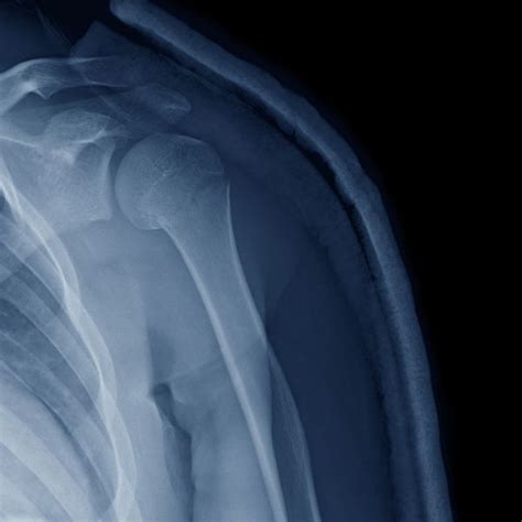 Proximal Humerus Fracture Fixation Shoulder Surgeon South Windsor