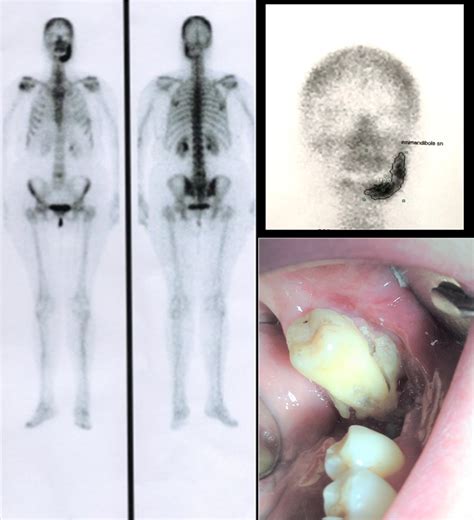 Diagnostic Accuracy Of Bone Scintigraphy In The Early Prediction Of