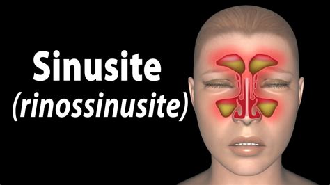 Dor No Maxilar Sinusite