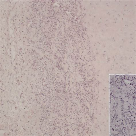 Hyaline Cartilage Pinna Containing Numerous Inflammatory Cells With