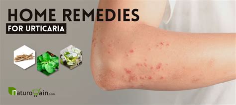10 Effective And Best Home Remedies For Urticaria