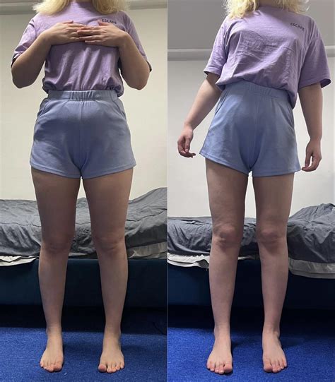 Beforeafter Of Thigh Love Handle Liposuction Hip Dip Fat Grafting