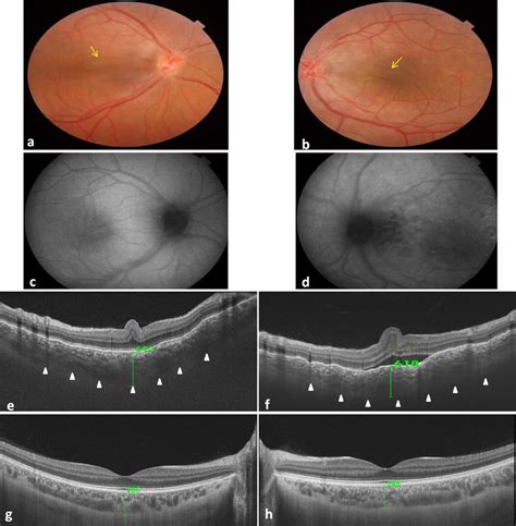 Measurement Of Subfoveal Choroidal Thickness Sfct Using Ss Oct In