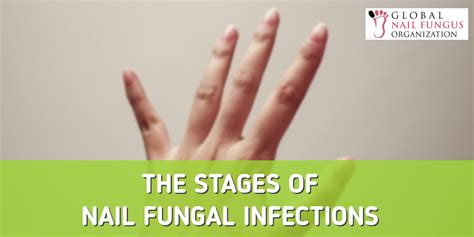 The Stages Of A Nail Fungal Infection Gnfo