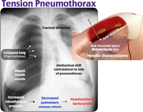 Image Tension Pneumothorax Needle Decompression