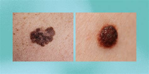 How To Tell If Your Suspicious Mole Might Be Skin Cancer Personalcare360