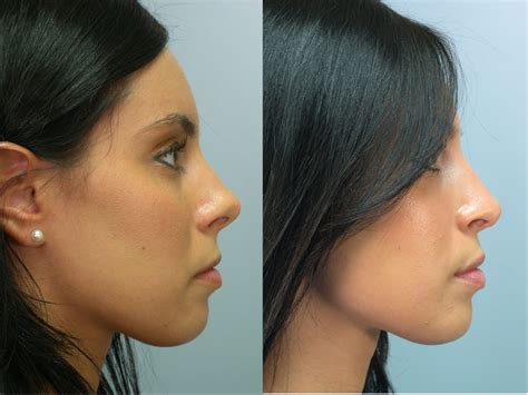 How Much Does Nose Surgery Cost With Insurance Dayle Klinger